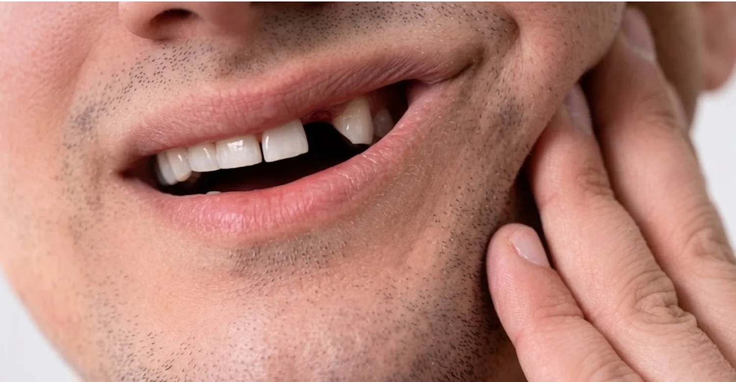 Dentinogenesis Imperfecta and Tooth Loss1
